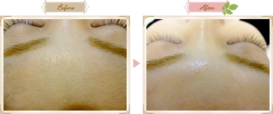 炭酸フェイスワックス施術例