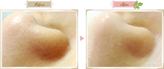 小鼻&口ヒゲWAX脱毛施術例